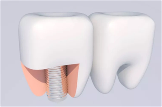 牙樁、牙冠、活動義齒修復材料，怎么選？