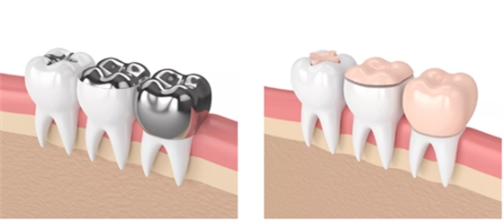 牙樁、牙冠、活動義齒修復材料，怎么選？