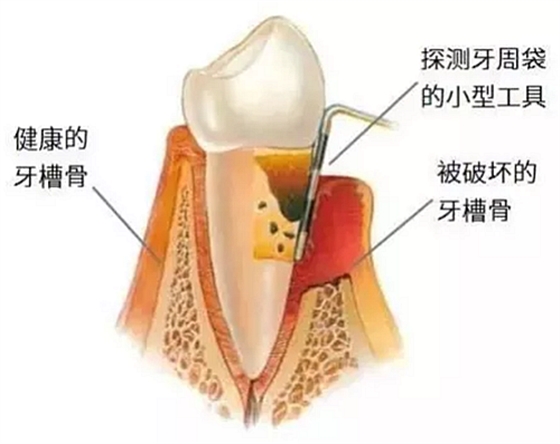 上海嘉福口腔研究所二十一世紀牙周病的臨床進展