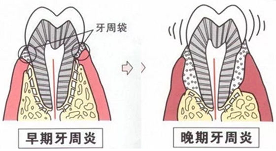 上海嘉?？谇谎芯克皇兰o牙周病的臨床進展