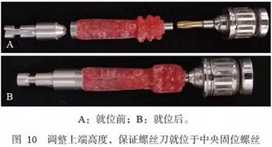 下頜骨腓骨移植聯(lián)合牙種植術(shù)后的覆蓋義齒修復(fù)1例