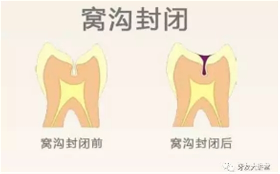 兒童防齲齒【窩溝封閉】和【涂氟】是一回事兒嗎？