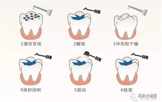 兒童防齲齒【窩溝封閉】和【涂氟】是一回事兒嗎？