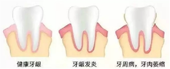 牙周炎，中國成年人后半生永遠的 痛 ！