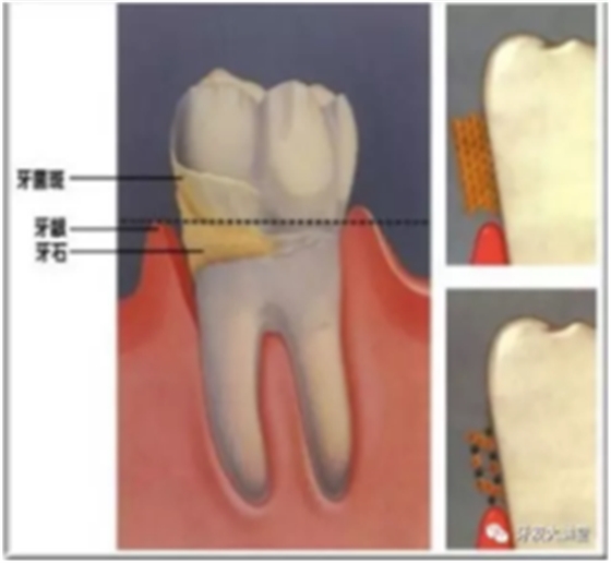 牙周炎，中國成年人后半生永遠的 痛 ！