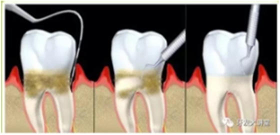 牙周炎，中國成年人后半生永遠的 痛 ！