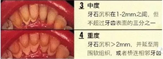 牙周炎，中國成年人后半生永遠的 痛 ！