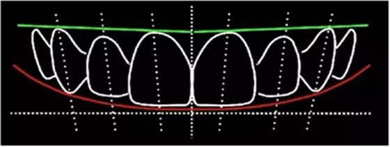 Asc全瓷角度基臺(tái)一體冠進(jìn)行種植前牙美學(xué)修復(fù)一例