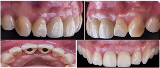 Asc全瓷角度基臺(tái)一體冠進(jìn)行種植前牙美學(xué)修復(fù)一例