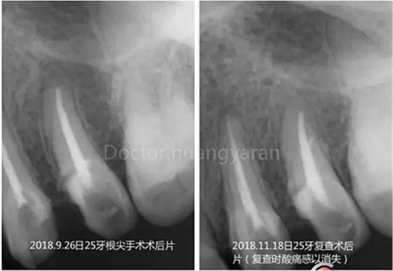 當(dāng)根管治療遇見(jiàn)根尖骨穿孔