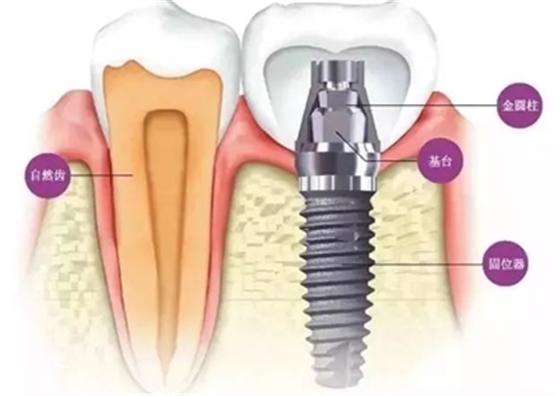 延長(zhǎng)種植牙使用壽命的方法
