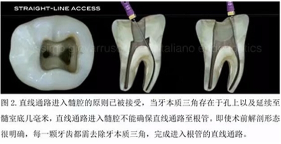 【病例分享】根管冠部預敞