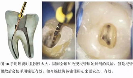 【病例分享】根管冠部預敞