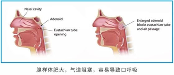 兒童早期矯治問題