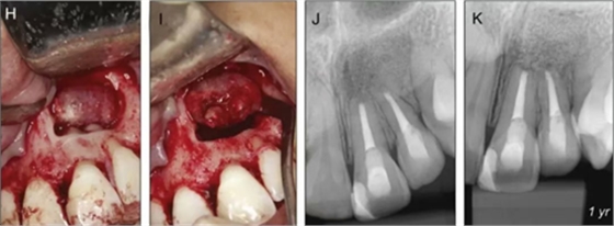 【病例分享】治療后的根尖周炎與根尖外的獨立感染
