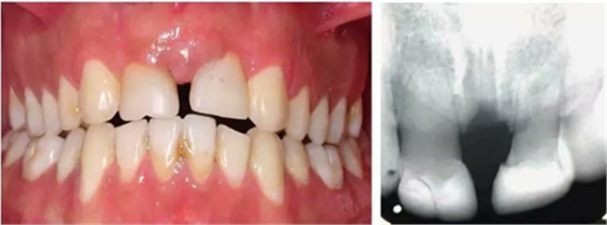 【病例分享】上頜中切牙區(qū)外傷的自體移植和正畸治療
