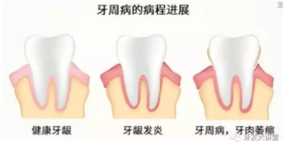 怎樣預防牙齦萎縮