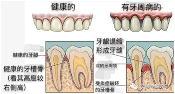 牙齦萎縮怎么辦？