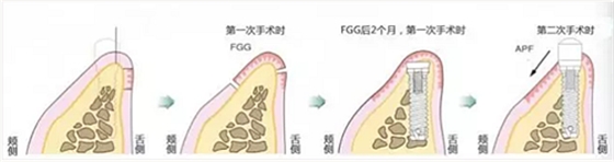 種植體周圍角化齦的獲得時期與方法