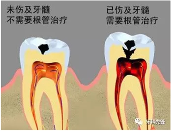 補(bǔ)牙不做冠，療效少一半！根管治療后牙齒已經(jīng)不疼了，為什么還要戴牙冠呢？