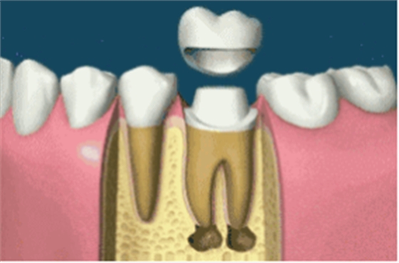 補(bǔ)牙不做冠，療效少一半！根管治療后牙齒已經(jīng)不疼了，為什么還要戴牙冠呢？