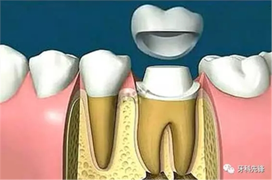 補(bǔ)牙不做冠，療效少一半！根管治療后牙齒已經(jīng)不疼了，為什么還要戴牙冠呢？