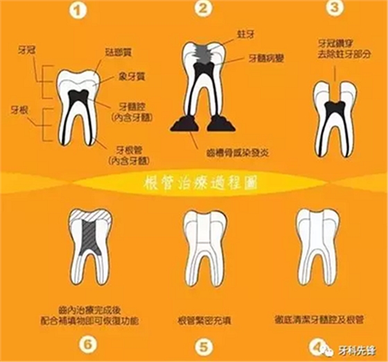 補(bǔ)牙不做冠，療效少一半！根管治療后牙齒已經(jīng)不疼了，為什么還要戴牙冠呢？