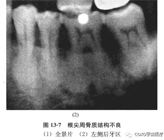 根尖周病與根尖周牙骨質(zhì)結(jié)構(gòu)不良