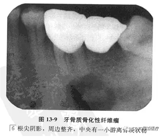 牙骨質(zhì)骨化性纖維瘤