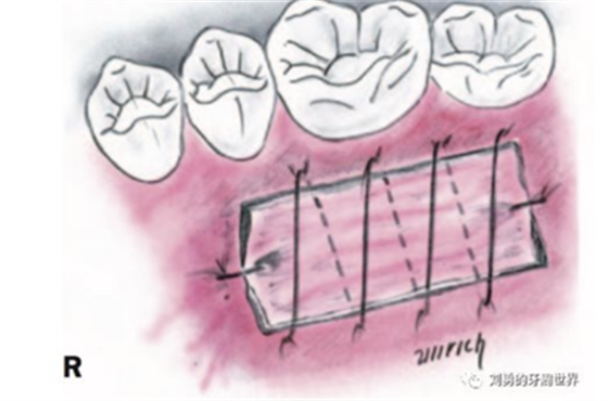 FGG游離牙齦移植在歷史上的各種改良以及發(fā)展前景