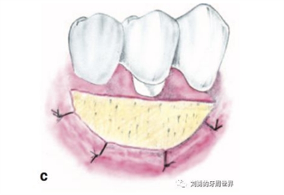 FGG游離牙齦移植在歷史上的各種改良以及發(fā)展前景