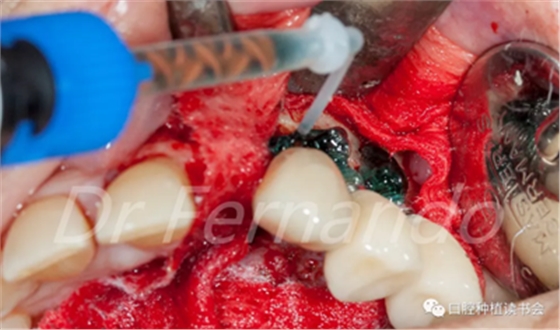 種植體周圍炎的軟硬組織重建治療(下)