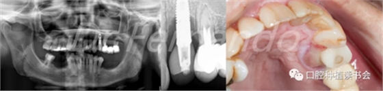 種植體周圍炎的軟硬組織重建治療(下)