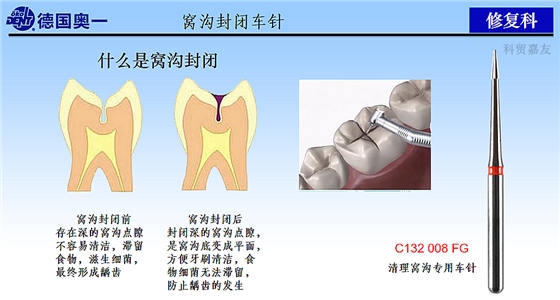 什么是窩溝封閉