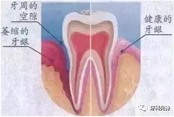 	牙齦萎縮是不治之癥？緩解牙齦萎縮5步走！