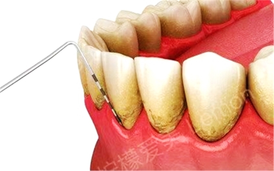 牙周病總是來勢洶洶？有辦法預(yù)防嗎？