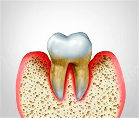 牙周病總是來勢洶洶？有辦法預(yù)防嗎？