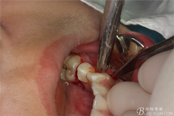 微創(chuàng)法摘除下頜第二前磨牙含牙囊腫