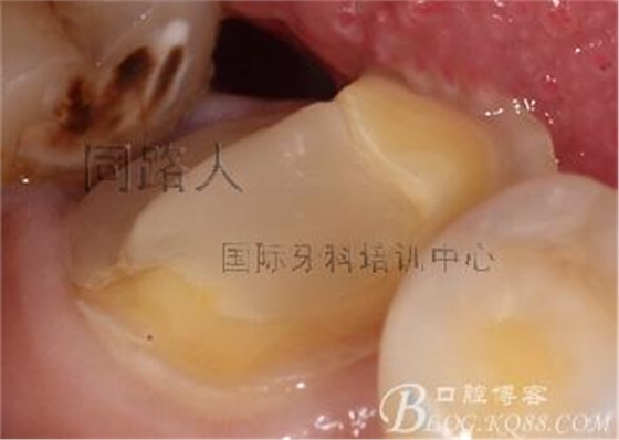 樹脂嵌體制作的階段性總結