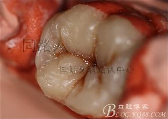 樹脂嵌體制作的階段性總結