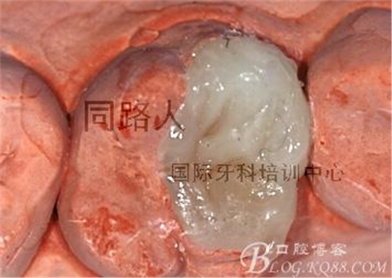 樹脂嵌體制作的階段性總結