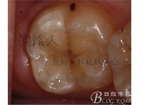 樹脂嵌體制作的階段性總結