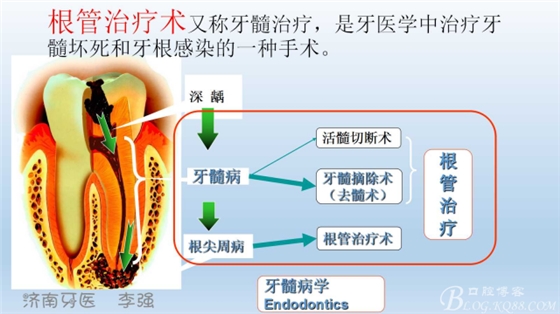 根管再治療，高嵌體即可修復（濟南牙醫(yī)~ 李強）