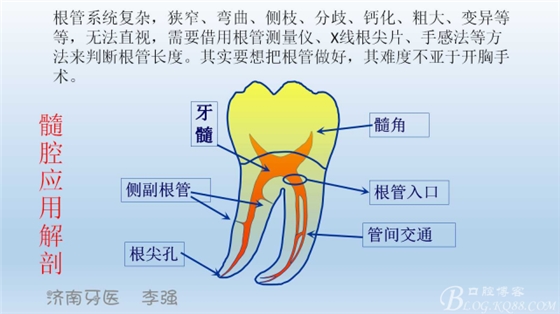 根管再治療，高嵌體即可修復（濟南牙醫(yī)~ 李強）