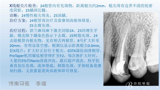 根管再治療，高嵌體即可修復（濟南牙醫(yī)~ 李強）