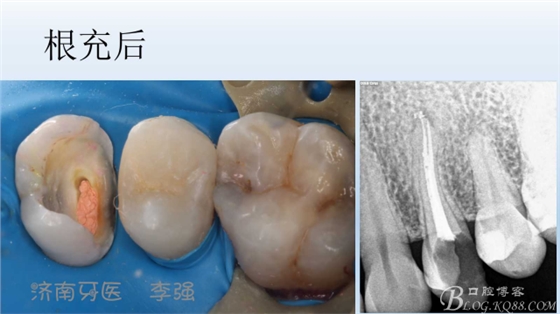 根管再治療，高嵌體即可修復（濟南牙醫(yī)~ 李強）