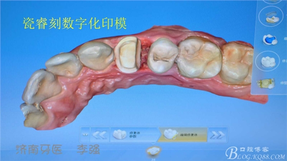 根管再治療，高嵌體即可修復（濟南牙醫(yī)~ 李強）