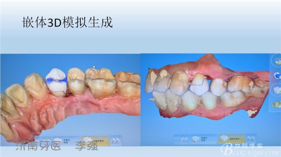 根管再治療，高嵌體即可修復（濟南牙醫(yī)~ 李強）