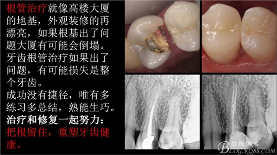 根管再治療，高嵌體即可修復（濟南牙醫(yī)~ 李強）