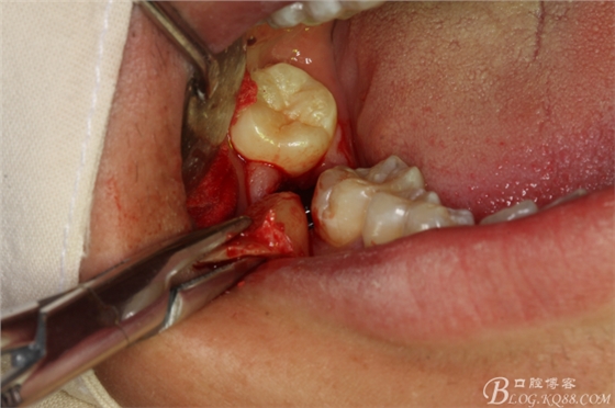 雙側(cè)下頜第二磨牙阻生牙的微創(chuàng)拔除